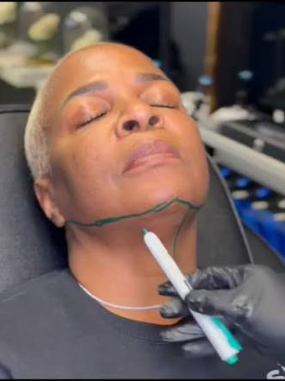 Liquid lipo consultation
