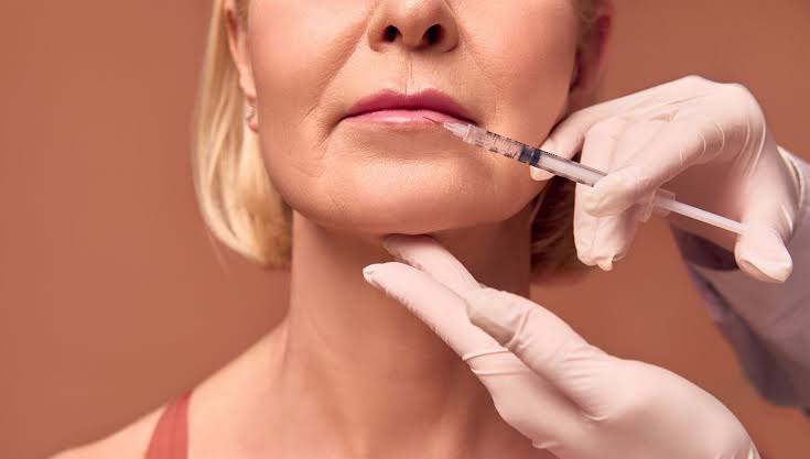Dermal filler procedure